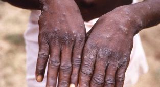 Afrika'da maymun çiçeğine karşı aşılamalara başlanacak