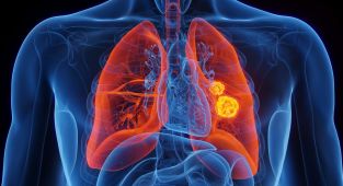 Araştırmaya göre ABD'de 50 yaş altı kişilerde görülen kanser vakaları arttı