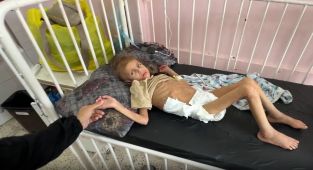 DSÖ: Gazze'de son 2 ayda 10 bin çocuğa akut yetersiz beslenme teşhisi konuldu