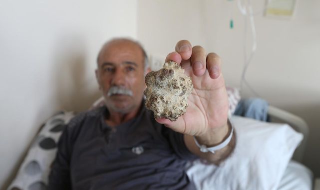 Doktorları şaşırttı: Elma büyüklüğünde taş çıktı